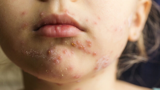 chickenpox