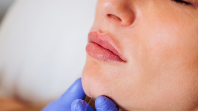 lip filler